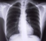 Tuberkulozes slimnieku skaits trīskāršojies
