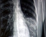 Liepājniekiem no tuberkulozes epidēmijas nav jābaidās