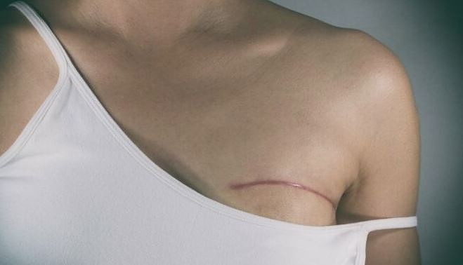 Pacientes slikti informētas par krūšu protēžu saņemšanu