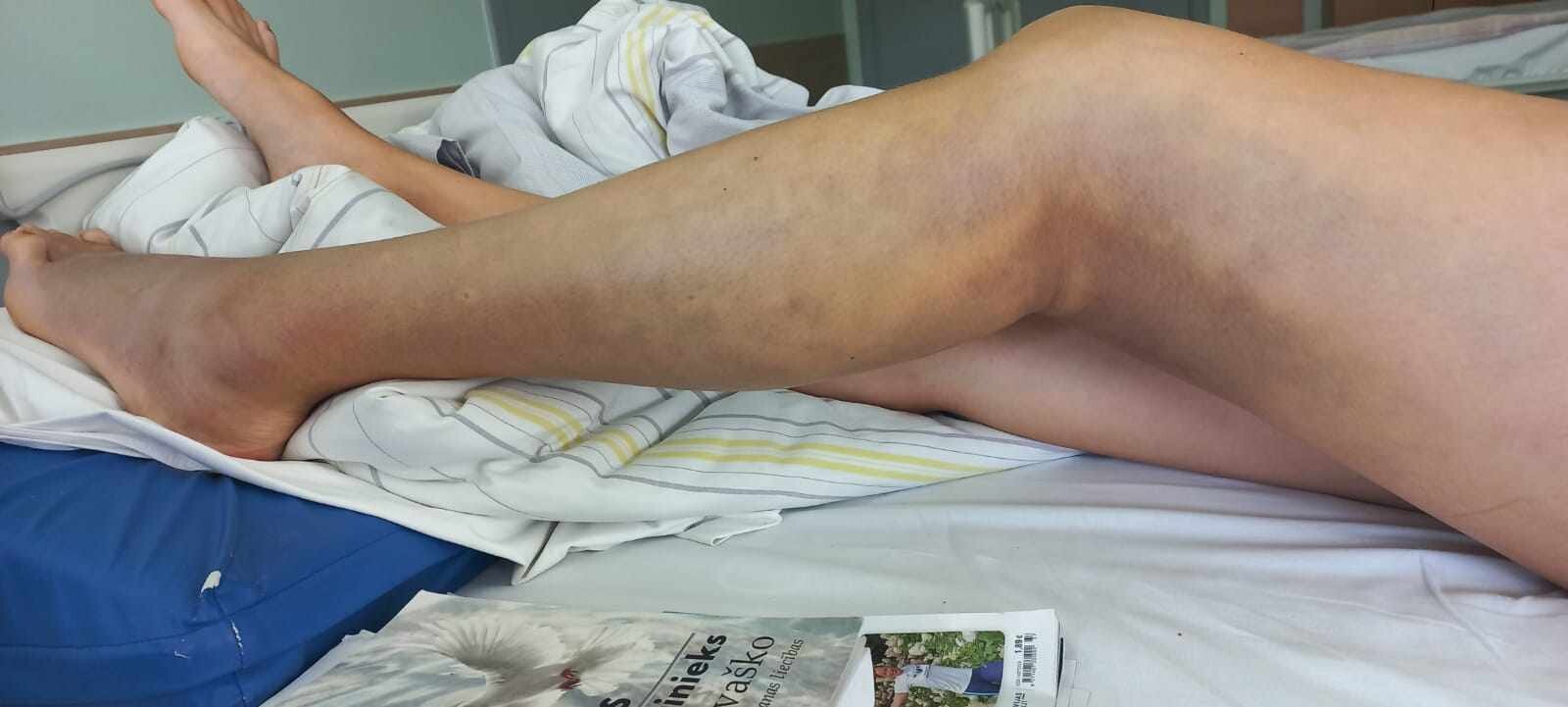 Pēc odzes koduma Bernātu kāpās sieviete nokļūst slimnīcā