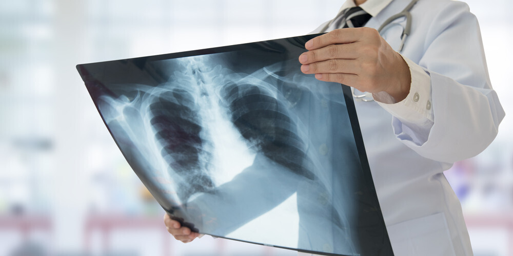 SPKC aicina bez maksas pārbaudīt plaušas un saņemt speciālistu konsultācijas par tuberkulozes profilaksi