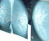 Iegādāts jauns mammogrāfijas aparāts