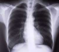 Tuberkulozes slimnieku skaits trīskāršojies