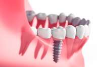 Vai īsto zobu aizstāšana ar implantiem ir tā vērta?